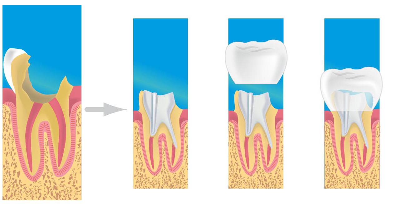 couronne dentiste paris 13